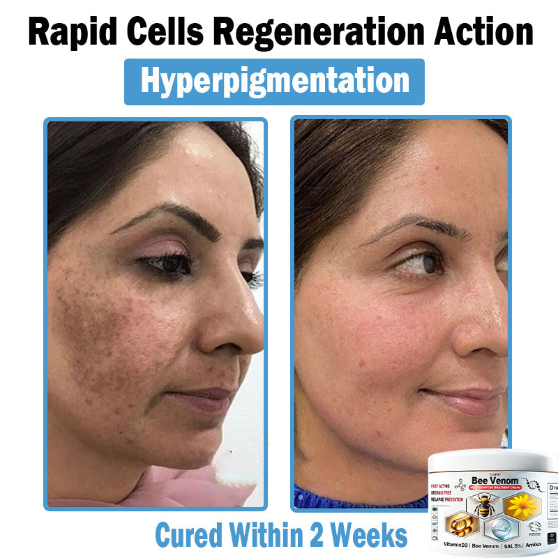 TLOPA® Bee Venom Multi-Symptom Skin Treatment Cream (👨⚕BAD RECOMMENDS)💎