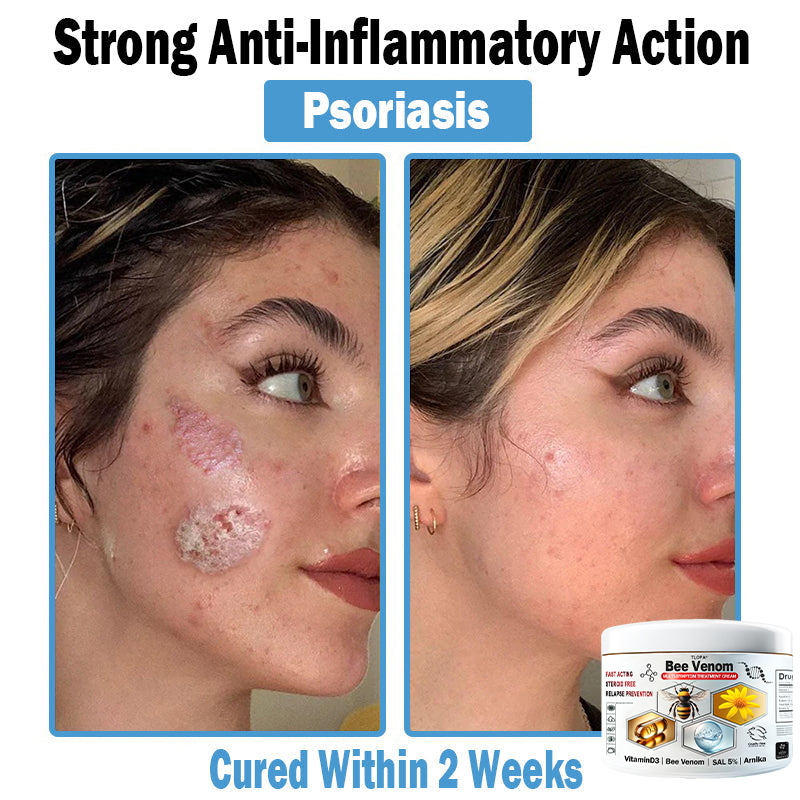 TLOPA® Bee Venom Multi-Symptom Skin Treatment Cream (👨⚕BAD RECOMMENDS)💎