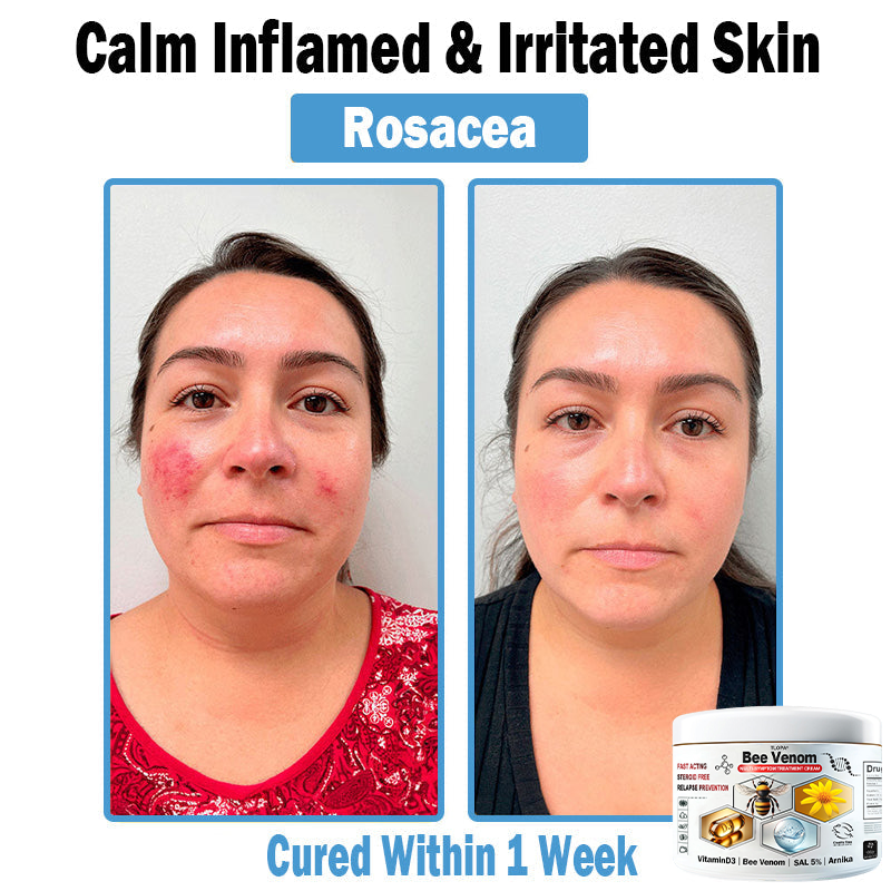 TLOPA® Bee Venom Multi-Symptom Skin Treatment Cream (👨⚕BAD RECOMMENDS)💎