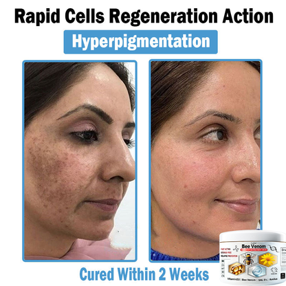 TLOPA® Bee Venom Multi-Symptom Skin Treatment Cream (👨‍⚕BAD RECOMMENDS)💎
