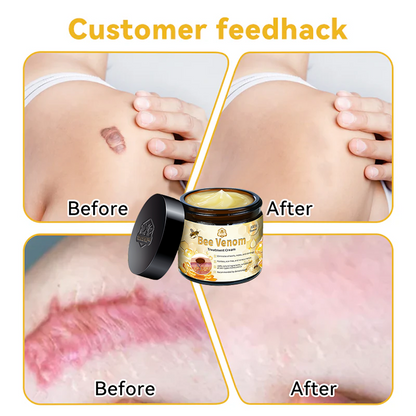 TLOPA® Bee Venom Skin Treatment Cream🌟（𝐵𝐴𝐷  𝑅𝑒𝑐𝑜𝑚𝑚𝑒𝑛𝑑𝑒𝑑）(🔥𝑳𝒂𝒔𝒕 𝒅𝒂𝒚 𝒑𝒓𝒐𝒎𝒐𝒕𝒊𝒐𝒏 70% 𝒐𝒇𝒇)